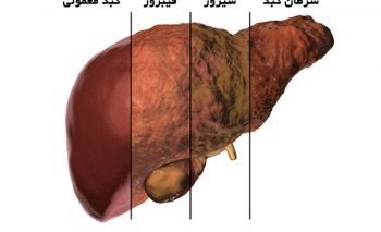 کبد چرب