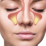 درمان سینوزیت