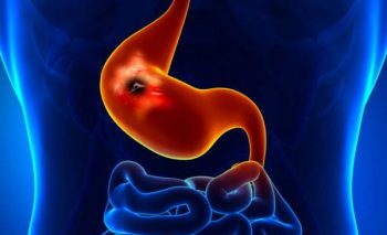 هلیکوباکتر